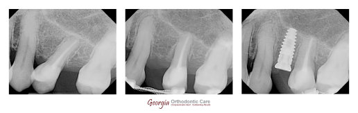 Missing teeth, dental implant, orthodontist, orthodontic treatment, Lawrenceville, Norcross, GA, Nguyen Orthodontics, Georgia Orthodontic 
Care