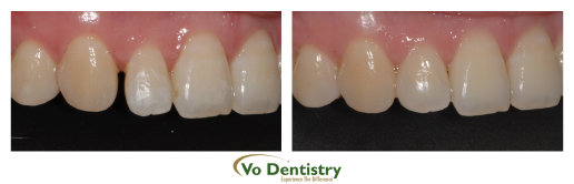 Orthodontic treatment, close spaces, composite, tooth colored, fillings, veneers,  orthodontist, cosmetic dentistry, Georgia Orthodontic 
Care, Vo Dentistry, Lawrenceville, Norcross, Lilburn, Dacula, buford, duluth, snellville, hamilton mill, grayson, sugar hill, sugar 
loaf, GA, Georgia, 30019, 30044, 30045